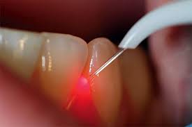 Зубы лечение лазером самара