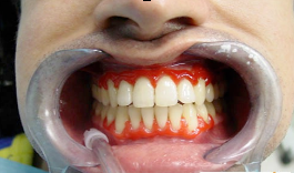 Зубы лечение лазером самара thumbnail